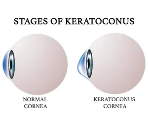 Keratoconus progression stages